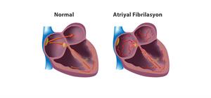 atrial fibrilasyon